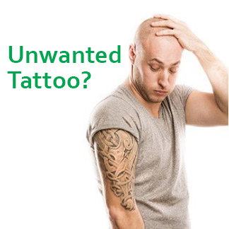 tattoo-removal